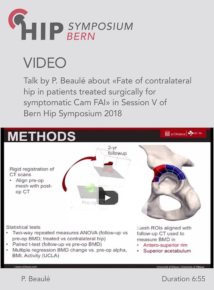 P. Beaulé - Fate of contralateral hip in patients treated surgically for symptomatic Cam FAI - Hip S