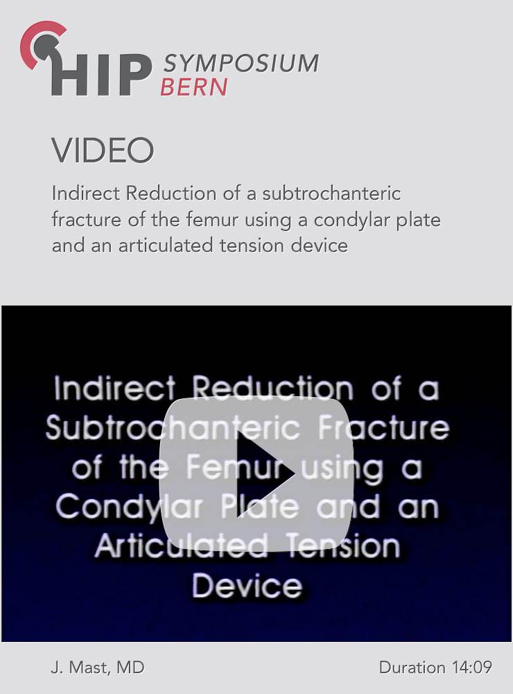 Indirect Reduction of a subtrochanteric fracture of the femur using a condylar plate and an articulated tension device