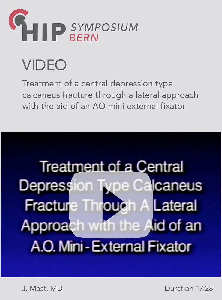Treatment of a central depression type calcaneus fracture through a lateral approach with the aid of an AO mini external fixator
