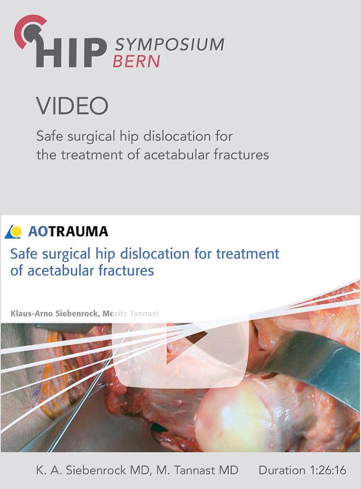 Safe surgical hip dislocation for the treatment of acetabular fractures 