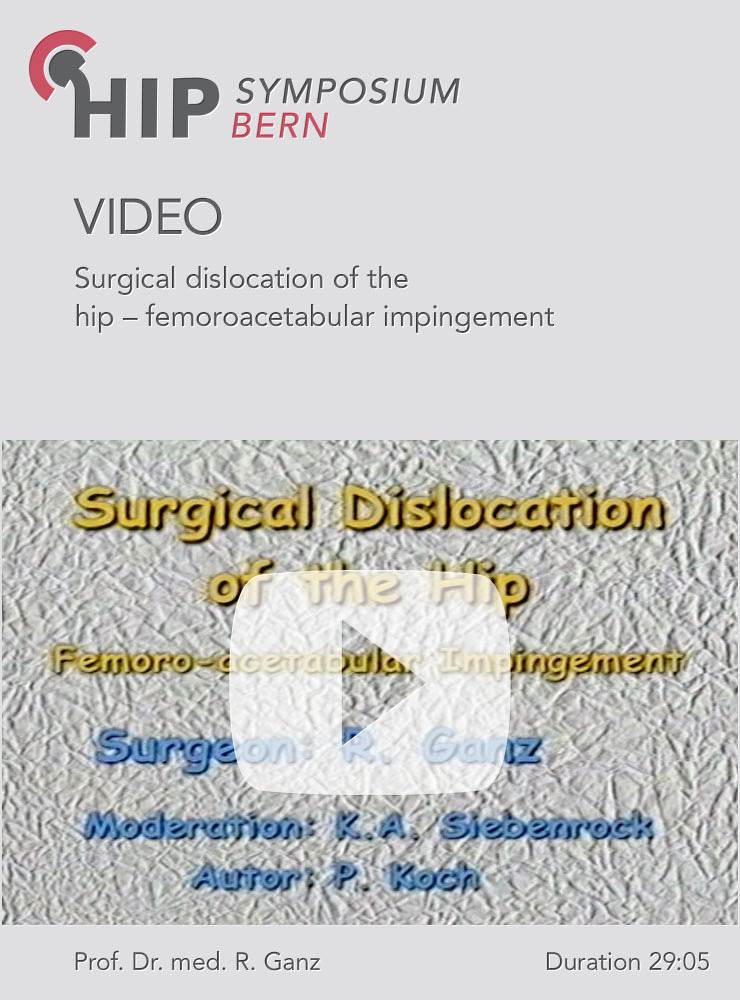 Surgical dislocation of the hip – femoroacetabular impingement 