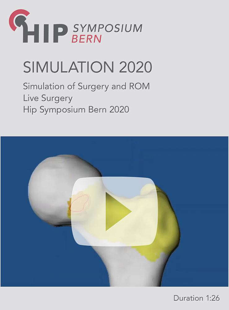 Simulation of Surgery and ROM - Live Surgery Case HSB 2020
